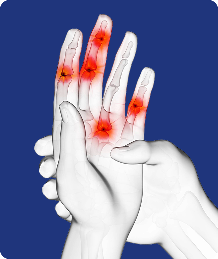 류마티스 관절염